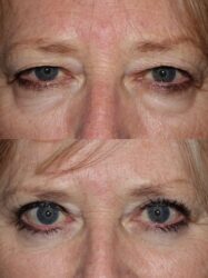 Upper and Lower Blepharoplasty Upper and Lower Blepharoplasty
