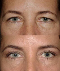 Brow lift with upper and lower blepharoplasty