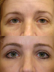 Upper and Lower Blepharoplasty Upper and Lower Blepharoplasty