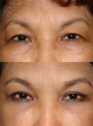 Upper and Lower Blepharoplasty Upper and Lower Blepharoplasty