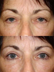 Upper and Lower Blepharoplasty Upper and Lower Blepharoplasty
