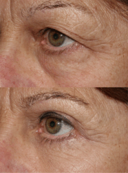 Outer brow lift with upper and lower blepharoplasty Outer brow lift with upper and lower blepharoplasty