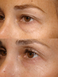 Customized cosmetic eyelid surgery - Lower and Upper Blepharoplasty
