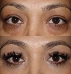 Lower blepharoplasty with fat repositioning