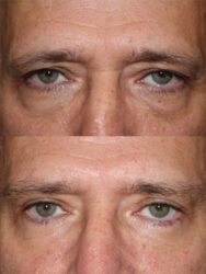 Male brow lift with upper and lower blepharoplasty