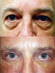 Upper and Lower Blepharoplasty - Male Blepharoplasty Upper and Lower Blepharoplasty - Male Blepharoplasty