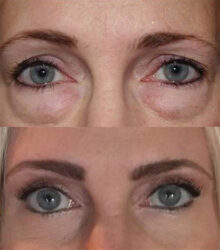 Revisional Fat grafting repair, outer brow lift, and upper and lower blepharoplasty