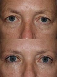 Upper and Lower Blepharoplasty with Outer Browlift Upper and Lower Blepharoplasty with Outer Browlift