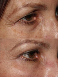 Upper and lower blepharoplasty, fat repositioning, and brow lift
