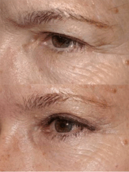Upper and lower blepharoplasty with outer browlift