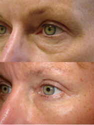 Canthoplasty