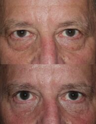 Lower blepharoplasty, canthoplasty, fat-graft, skin excision before and after canthoplasty