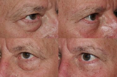 Lower blepharoplasty, canthoplasty, with fat graft and skin excision before and after canthoplasty