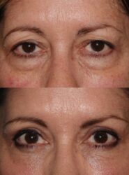 before and after upper and lower blepharoplasty with fat grafting on the lower lid before and after