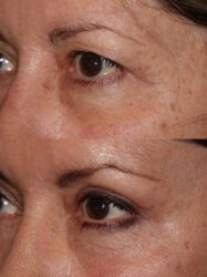 before and after upper and lower blepharoplasty with fat grafting on the lower lid before and after