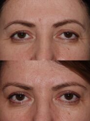 before and after brow lift with upper blepharoplasty and fat graft before and after