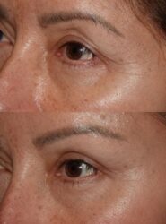before and after revisional upper blepharoplasty and fat graft before and after